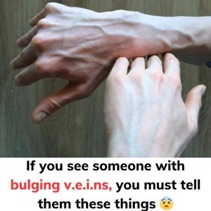 If you see someone with bulging veins, you must tell them these things